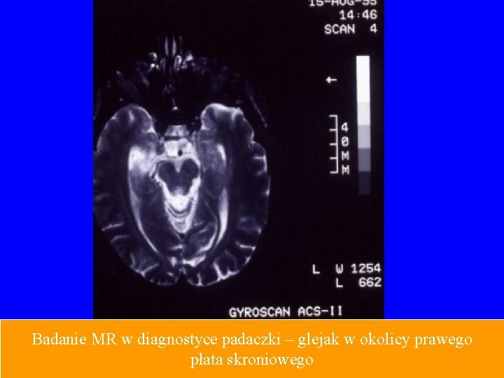 Badanie MR w diagnostyce padaczki – glejak w okolicy prawego płata skroniowego 