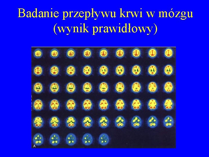 Badanie przepływu krwi w mózgu (wynik prawidłowy) 