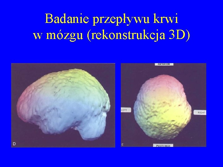 Badanie przepływu krwi w mózgu (rekonstrukcja 3 D) 