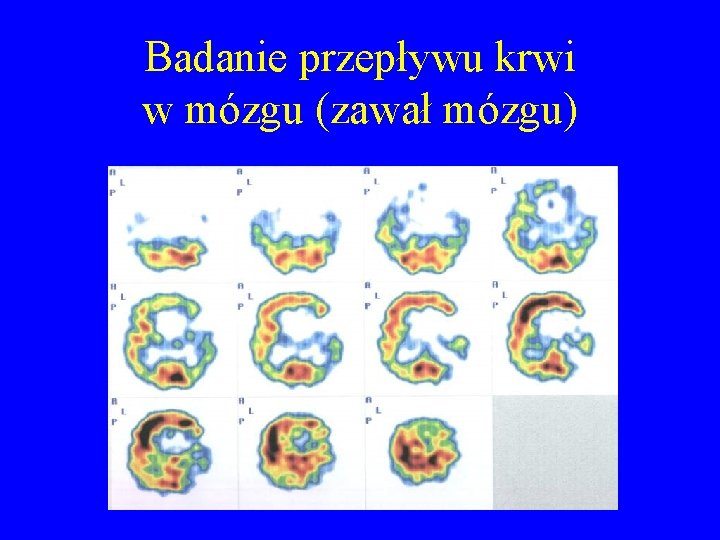 Badanie przepływu krwi w mózgu (zawał mózgu) 