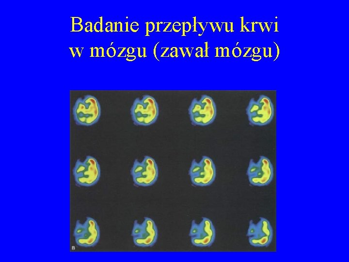 Badanie przepływu krwi w mózgu (zawał mózgu) 