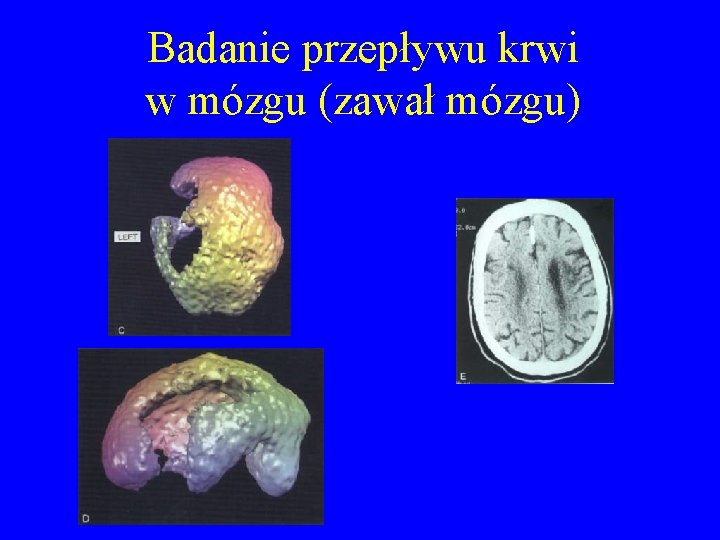 Badanie przepływu krwi w mózgu (zawał mózgu) 