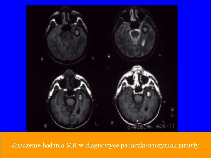 Znaczenie badania MR w diagnostyce padaczki-naczyniak jamisty 