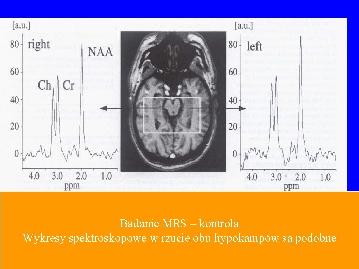 Badanie MRS – kontrola Wykresy spektroskopowe w rzucie obu hypokampów są podobne 