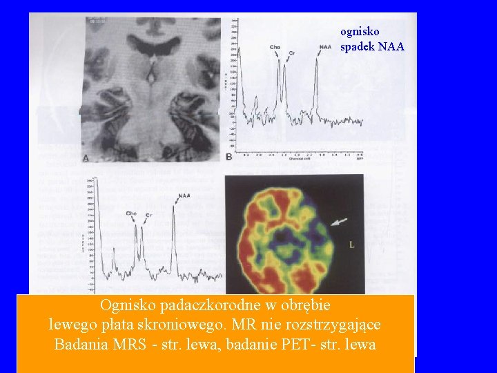 ognisko spadek NAA Ognisko padaczkorodne w obrębie lewego płata skroniowego. MR nie rozstrzygające Badania