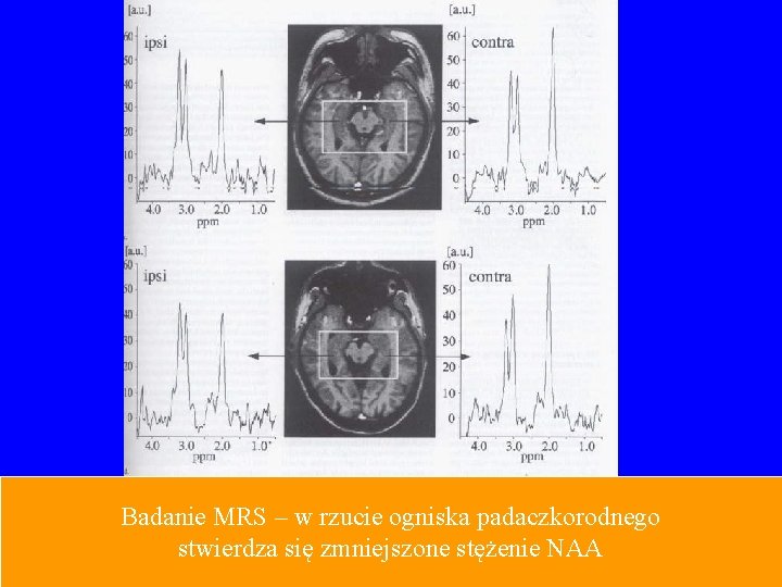 Badanie MRS – w rzucie ogniska padaczkorodnego stwierdza się zmniejszone stężenie NAA 