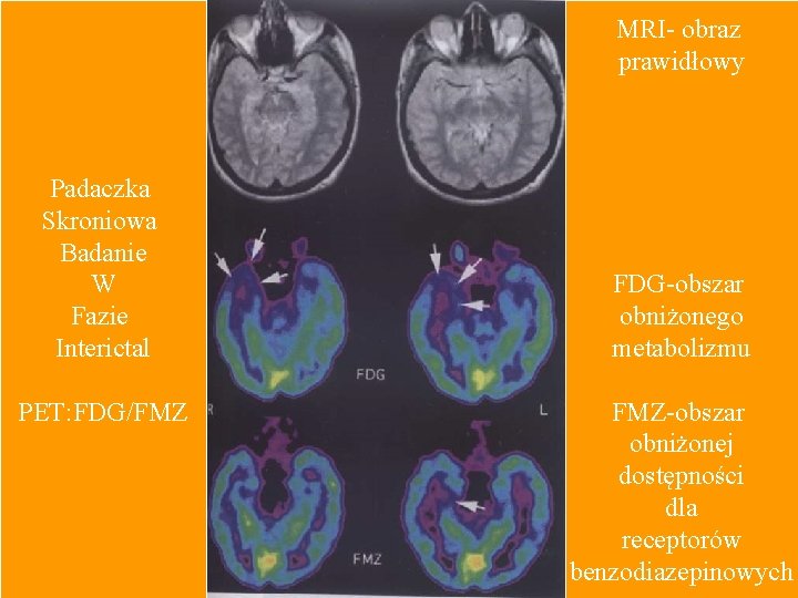 MRI- obraz prawidłowy Padaczka Skroniowa Badanie W Fazie Interictal PET: FDG/FMZ FDG-obszar obniżonego metabolizmu