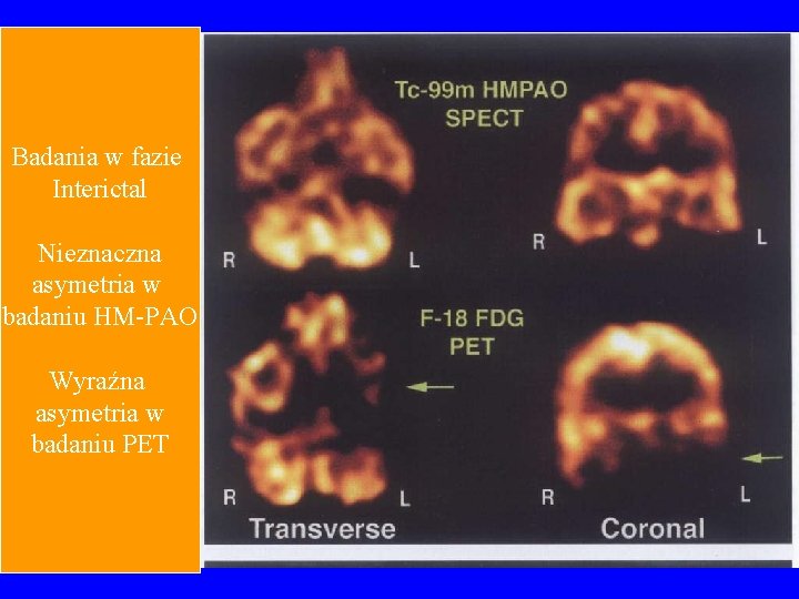 Badania w fazie Interictal Nieznaczna asymetria w badaniu HM-PAO Wyraźna asymetria w badaniu PET