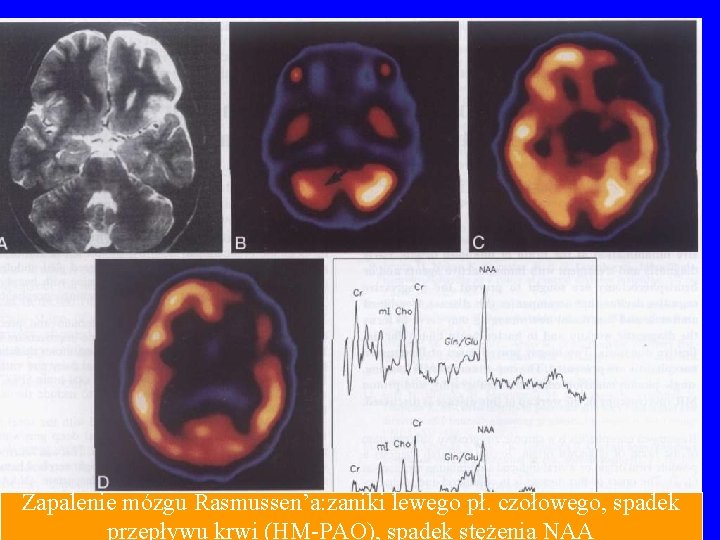 Zapalenie mózgu Rasmussen’a: zaniki lewego pł. czołowego, spadek przepływu krwi (HM-PAO), spadek stężenia NAA