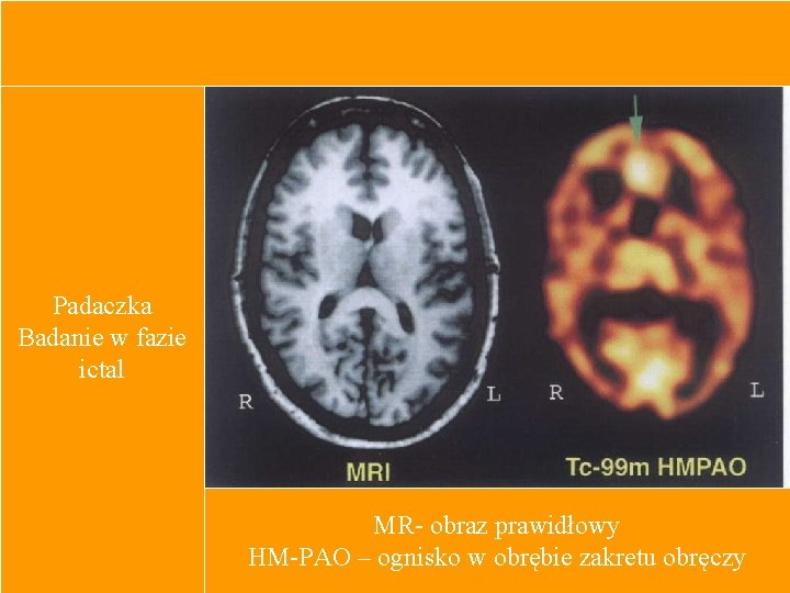 Padaczka Badanie w fazie ictal MR- obraz prawidłowy HM-PAO – ognisko w obrębie zakretu