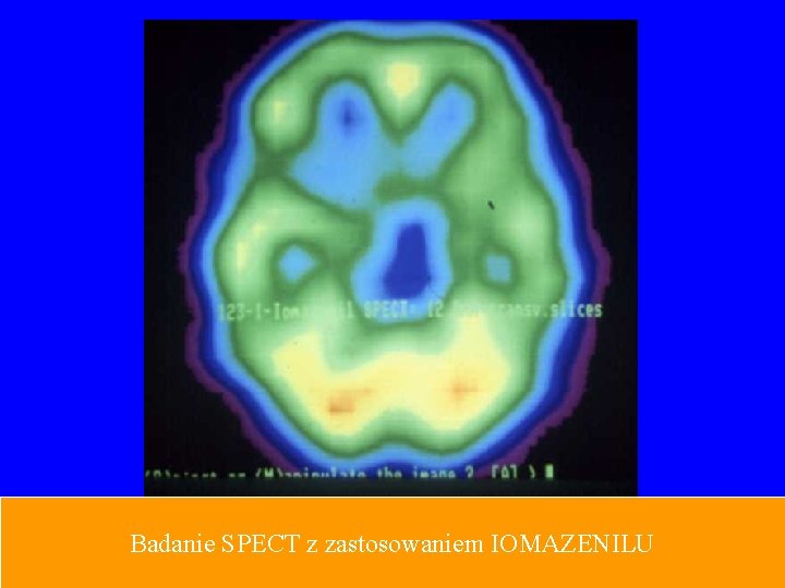 Badanie SPECT z zastosowaniem IOMAZENILU 