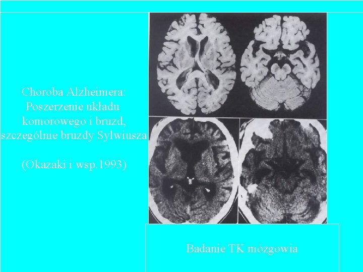 Choroba Alzheimera: Poszerzenie układu komorowego i bruzd, szczególnie bruzdy Sylwiusza (Okazaki i wsp. 1993)