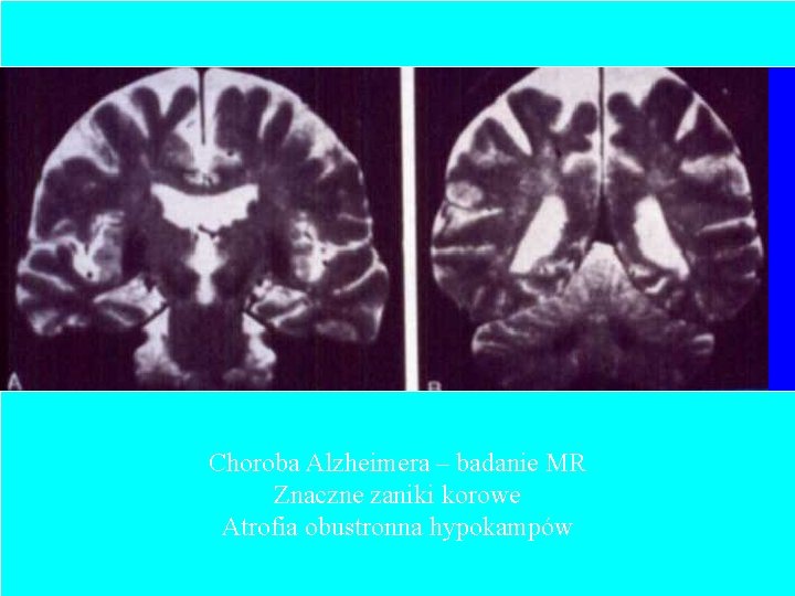 Choroba Alzheimera – badanie MR Znaczne zaniki korowe Atrofia obustronna hypokampów 