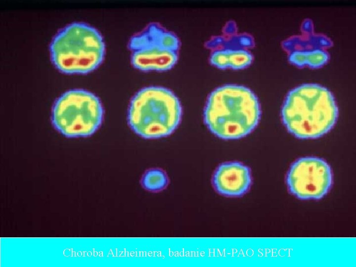 Choroba Alzheimera, badanie HM-PAO SPECT 