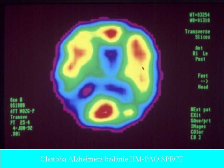 Choroba Alzheimera badanie HM-PAO SPECT 