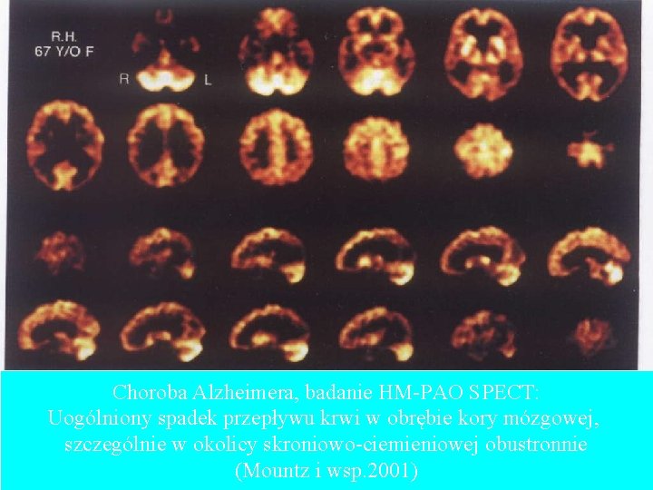 Choroba Alzheimera, badanie HM-PAO SPECT: Uogólniony spadek przepływu krwi w obrębie kory mózgowej, szczególnie