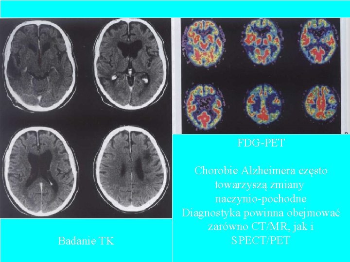 FDG-PET Badanie TK Chorobie Alzheimera często towarzyszą zmiany naczynio-pochodne Diagnostyka powinna obejmować zarówno CT/MR,