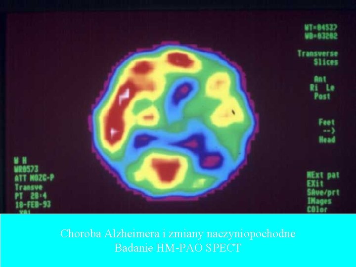 Choroba Alzheimera i zmiany naczyniopochodne Badanie HM-PAO SPECT 