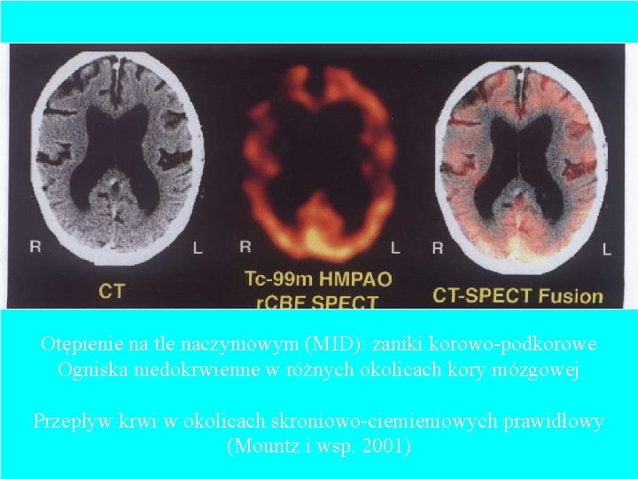 Otępienie na tle naczyniowym (MID): zaniki korowo-podkorowe Ogniska niedokrwienne w różnych okolicach kory mózgowej