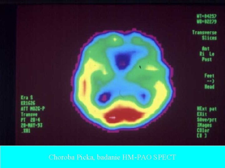 Choroba Picka, badanie HM-PAO SPECT 