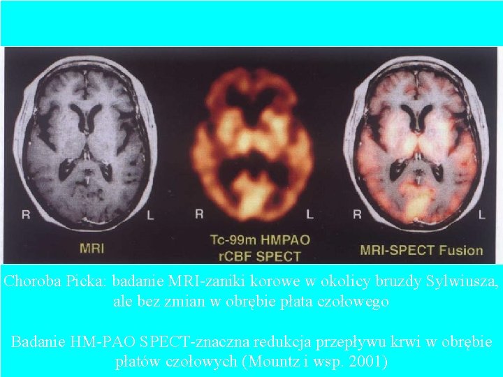 Choroba Picka: badanie MRI-zaniki korowe w okolicy bruzdy Sylwiusza, ale bez zmian w obrębie