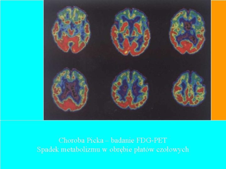 Choroba Picka – badanie FDG-PET Spadek metabolizmu w obrębie płatów czołowych 