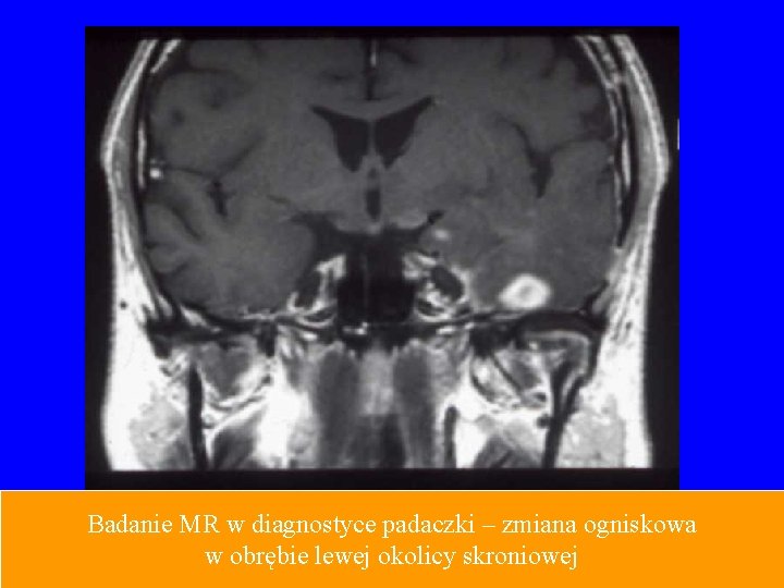 Badanie MR w diagnostyce padaczki – zmiana ogniskowa w obrębie lewej okolicy skroniowej 