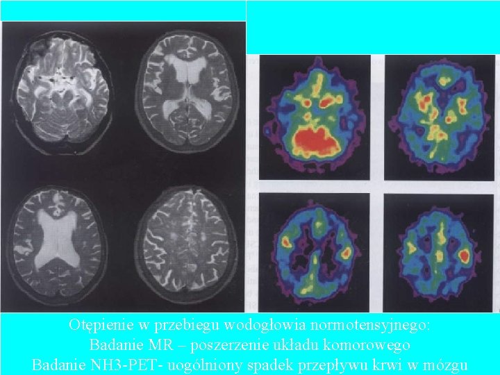 Otępienie w przebiegu wodogłowia normotensyjnego: Badanie MR – poszerzenie układu komorowego Badanie NH 3