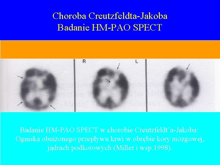 Choroba Creutzfeldta-Jakoba Badanie HM-PAO SPECT w chorobie Creutzfeldt’a-Jakoba: Ogniska obniżonego przepływu krwi w obrębie