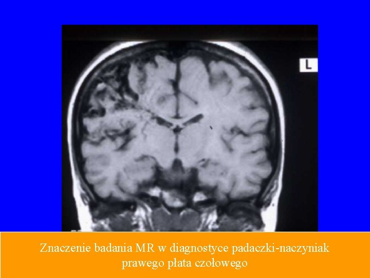 Znaczenie badania MR w diagnostyce padaczki-naczyniak prawego płata czołowego 