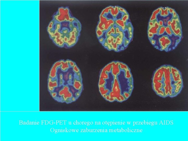 Badanie FDG-PET u chorego na otępienie w przebiegu AIDS Ogniskowe zaburzenia metaboliczne 