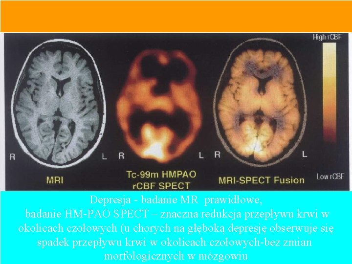 Depresja - badanie MR prawidłowe, badanie HM-PAO SPECT – znaczna redukcja przepływu krwi w