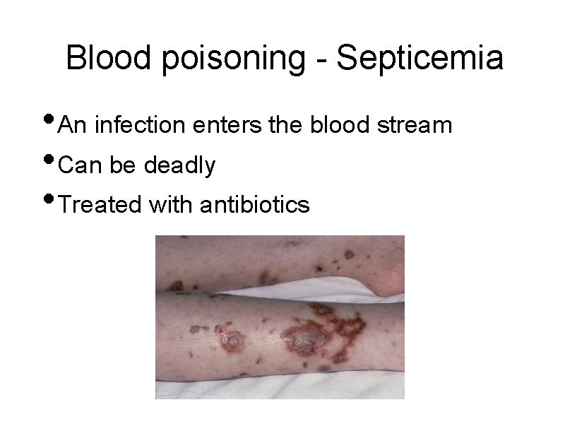 Blood poisoning - Septicemia • An infection enters the blood stream • Can be