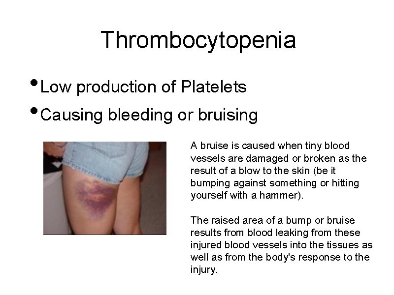 Thrombocytopenia • Low production of Platelets • Causing bleeding or bruising A bruise is