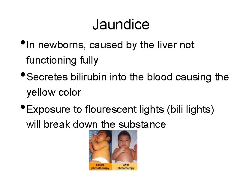 Jaundice • In newborns, caused by the liver not functioning fully • Secretes bilirubin