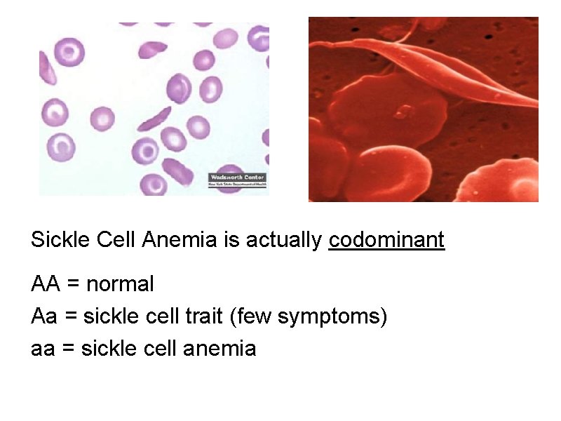 Sickle Cell Anemia is actually codominant AA = normal Aa = sickle cell trait