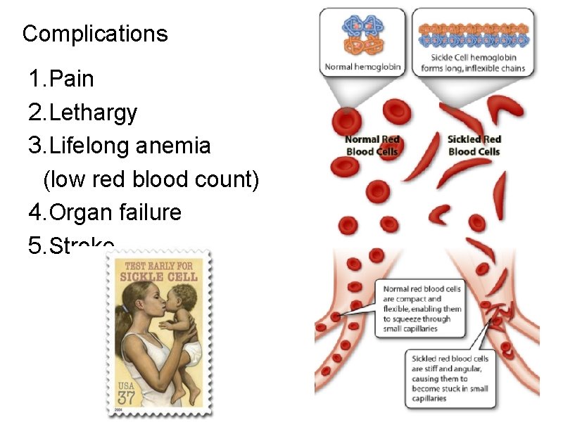 Complications 1. Pain 2. Lethargy 3. Lifelong anemia (low red blood count) 4. Organ
