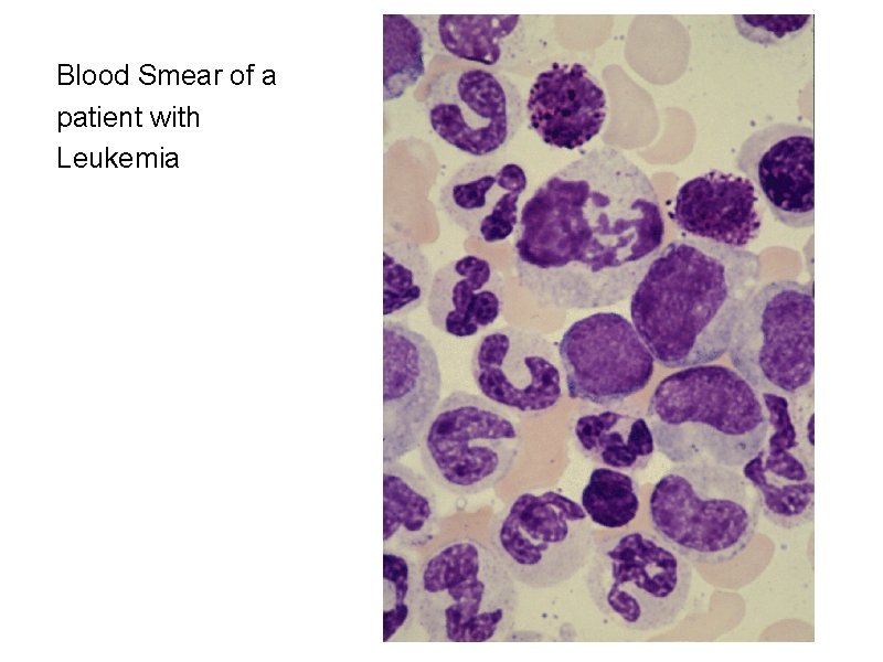 Blood Smear of a patient with Leukemia 