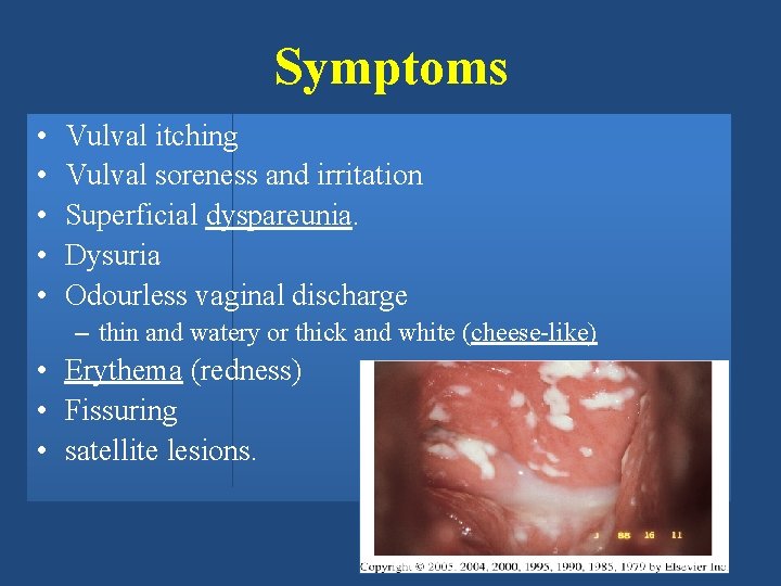 Symptoms • • • Vulval itching Vulval soreness and irritation Superficial dyspareunia. Dysuria Odourless