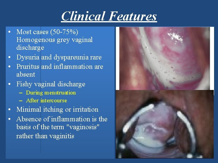 Clinical Features • Most cases (50 -75%) Homogenous grey vaginal discharge • Dysuria and