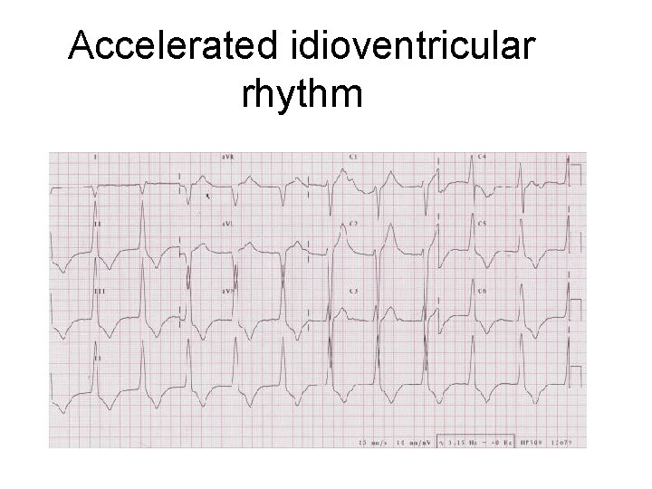 Accelerated idioventricular rhythm 