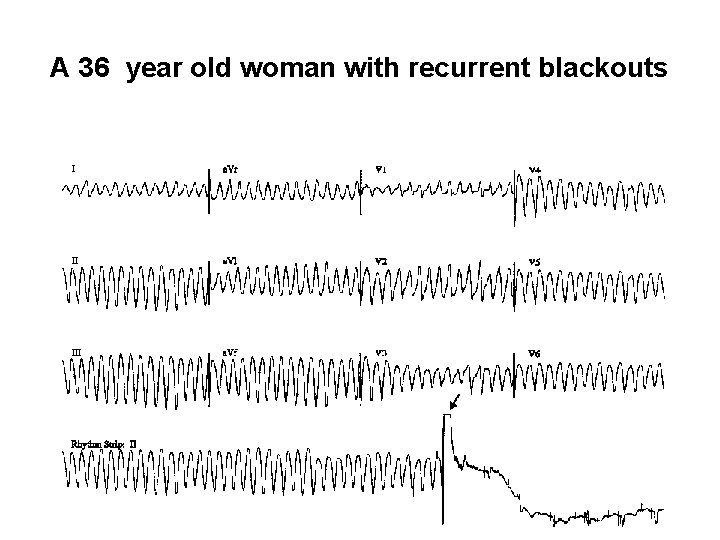 A 36 year old woman with recurrent blackouts 