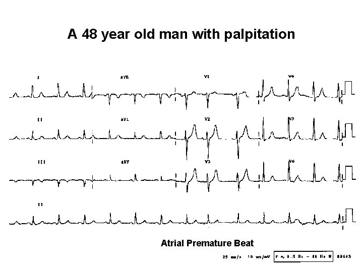 A 48 year old man with palpitation Atrial Premature Beat 