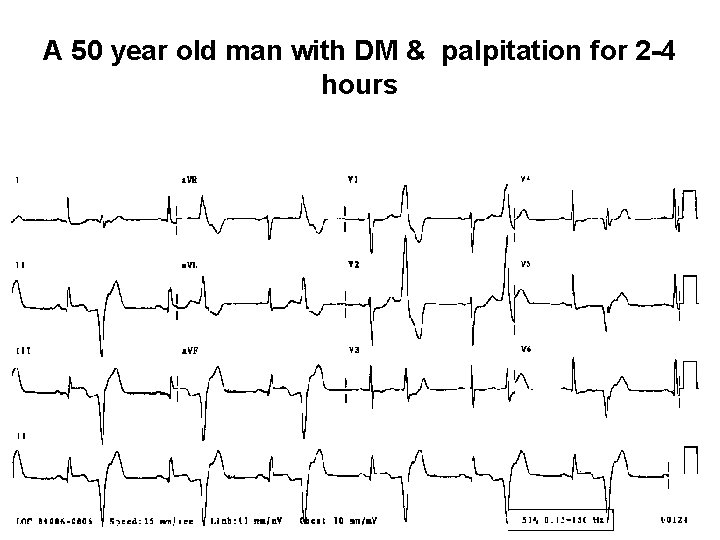 A 50 year old man with DM & palpitation for 2 -4 hours 