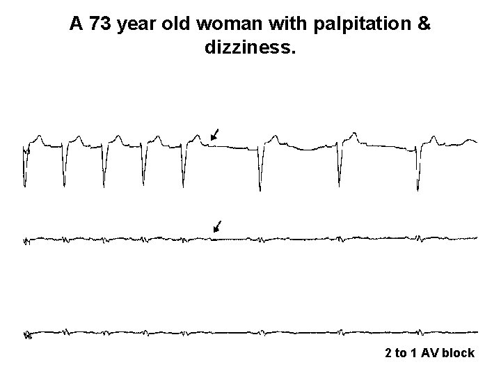A 73 year old woman with palpitation & dizziness. 2 to 1 AV block