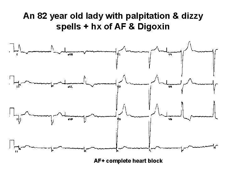An 82 year old lady with palpitation & dizzy spells + hx of AF