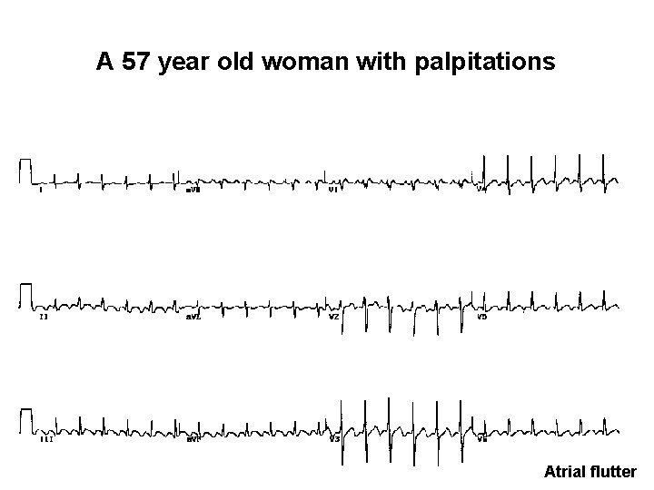 A 57 year old woman with palpitations Atrial flutter 