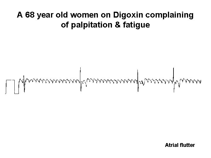A 68 year old women on Digoxin complaining of palpitation & fatigue Atrial flutter