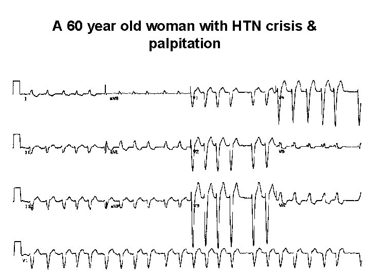 A 60 year old woman with HTN crisis & palpitation 