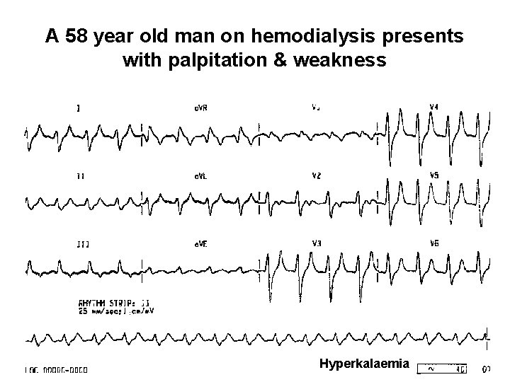 A 58 year old man on hemodialysis presents with palpitation & weakness Hyperkalaemia 